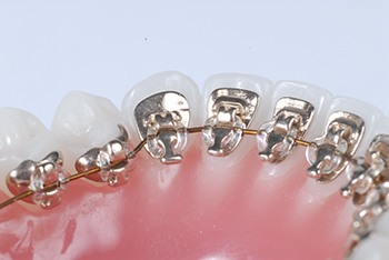 lingual braces